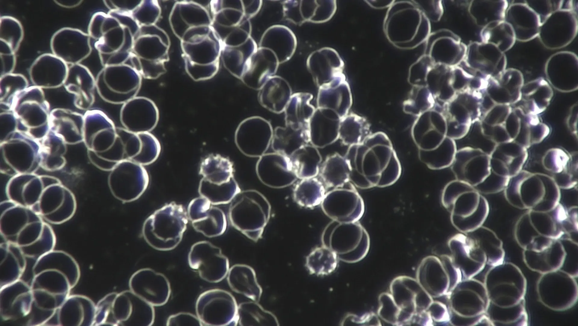 verformte Erythrozyten