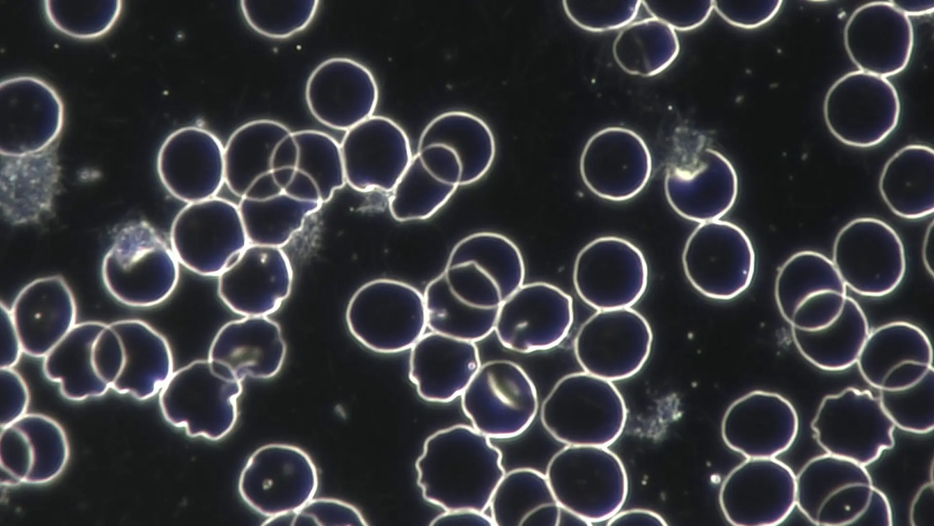 verformte Erythrozyten